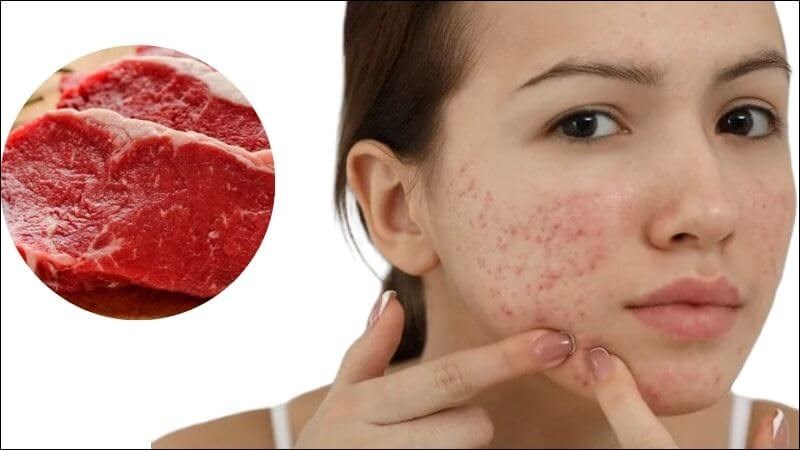 Người mắc bệnh da liễu ăn thịt bò có thể gây ngứa