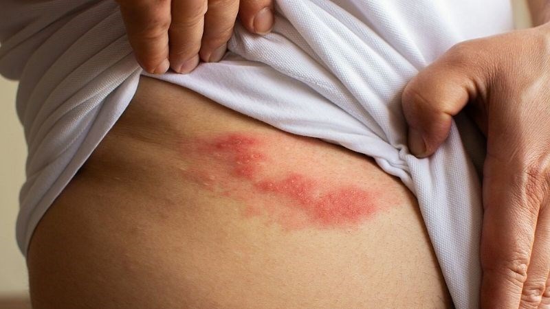 Zona thần kinh có thể dẫn đến dị cảm mạn tính