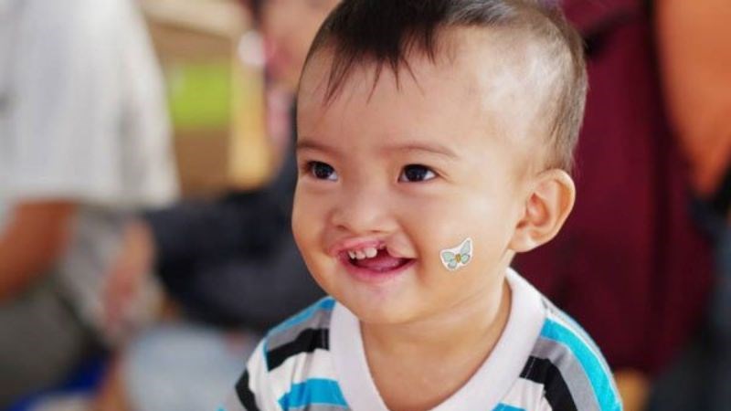 Hội chứng Edward là hội chứng gây ra nhiều bất thường về hình thái Hội chứng Edward là hội chứng gây ra nhiều bất thường về hình thái