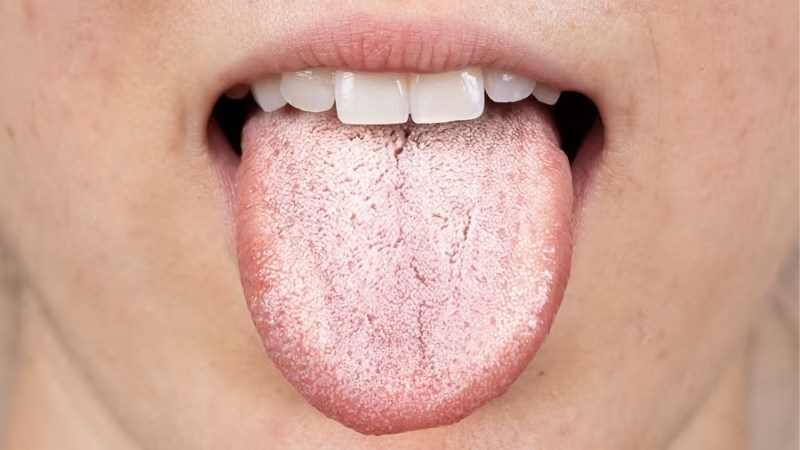 Tạm biệt tưa lưỡi khi thoa hỗn dịch có chứa lá sung với mật ong và lát mít khô 