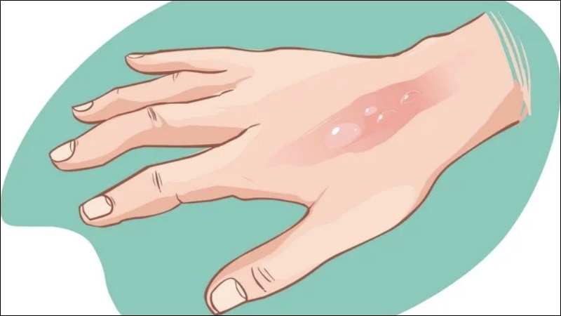 Bôi hỗn hợp có chứa lá sung vào vết bỏng, giúp da nhanh lành