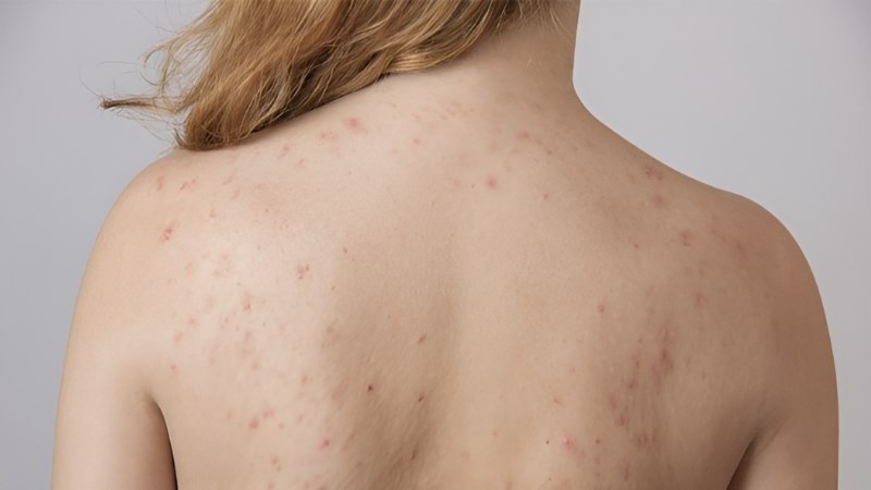 Những nốt đỏ ở lưng ngực sẽ cải thiện sau khi uống sản phẩm có chứa lá sung
