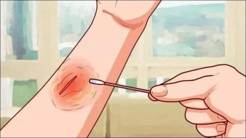 Lá vú sữa thúc đẩy quá trình làm lành vết thương