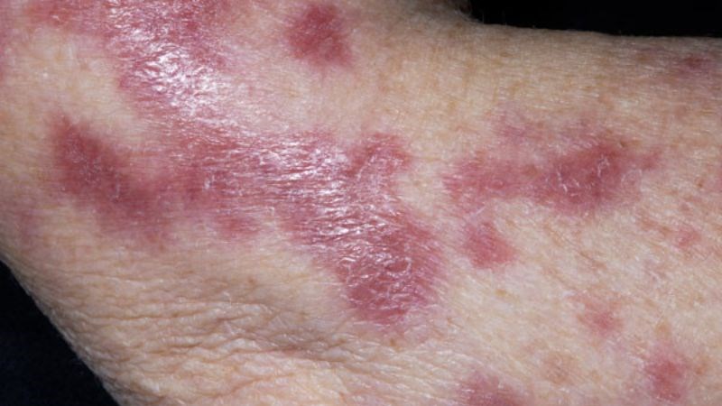 Lao da là bệnh do vi khuẩn lao gây ra những tổn thương đặc trưng trên da Lao da là bệnh do vi khuẩn lao gây ra những tổn thương đặc trưng trên da