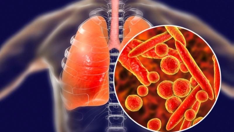 Lao da có thể xuất hiện thứ phát sau lao phổi Lao da có thể xuất hiện thứ phát sau lao phổi