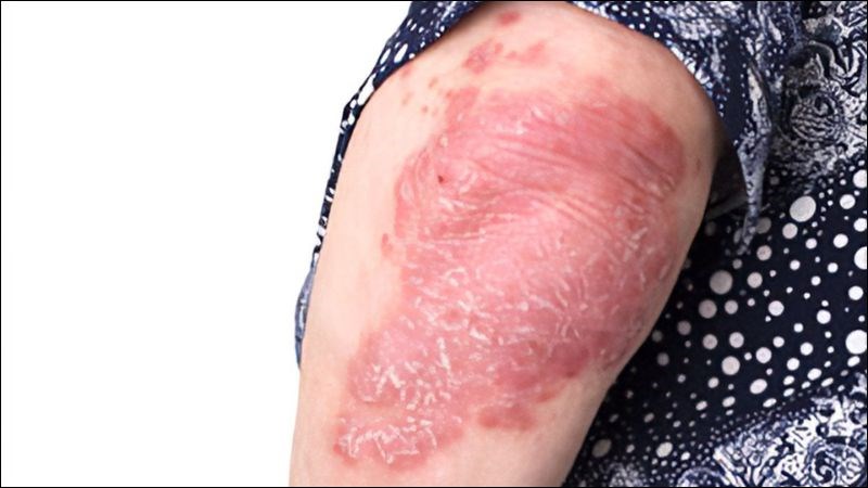 Người bệnh lao da có thể xuất hiện các mảng sẩn hồng nhạt đặc trưng Người bệnh lao da có thể xuất hiện các mảng sẩn hồng nhạt đặc trưng