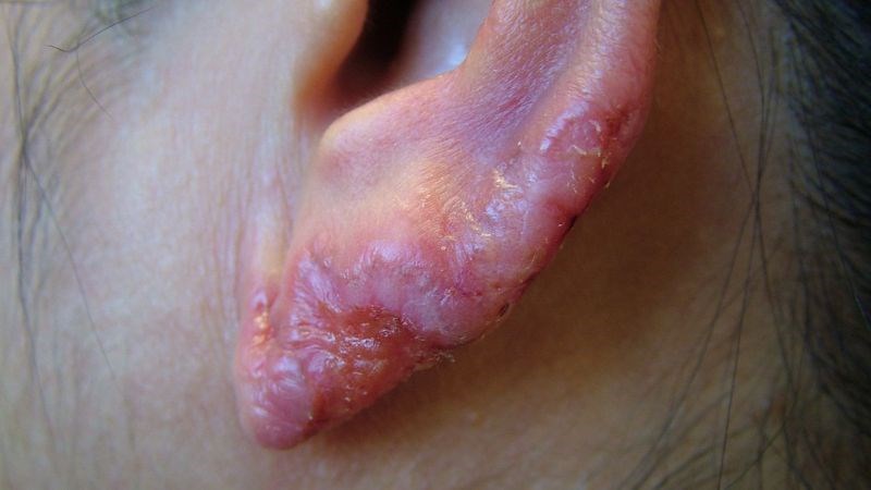 Người bệnh nên đến gặp bác sĩ sớm nếu xuất hiện các mảng da sẩn đỏ Người bệnh nên đến gặp bác sĩ sớm nếu xuất hiện các mảng da sẩn đỏ