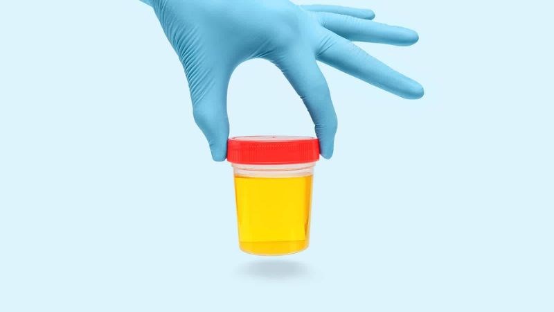 Xét nghiệm nước tiểu có thể giúp chẩn đoán bệnh lậu ở nam giới