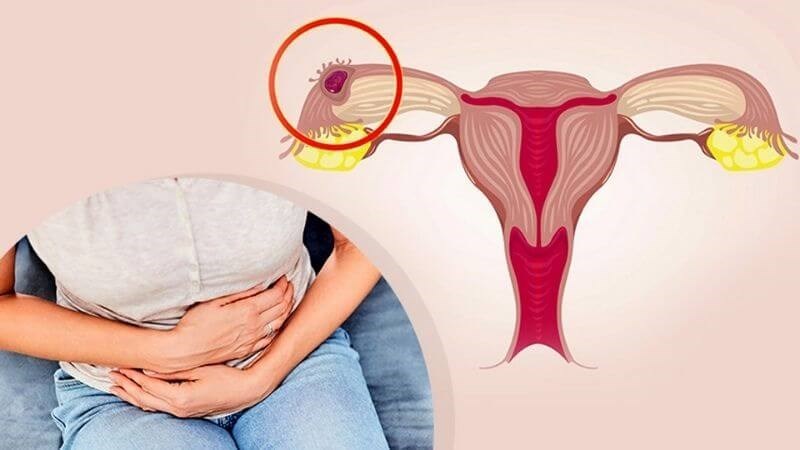 Thai ngoài tử cung có thể là biến chứng của bệnh lậu