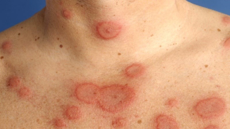 Lupus ban đỏ là một bệnh tự miễn gây ra tổn thương tại da và đa cơ quan Lupus ban đỏ là một bệnh tự miễn gây ra tổn thương tại da và đa cơ quan