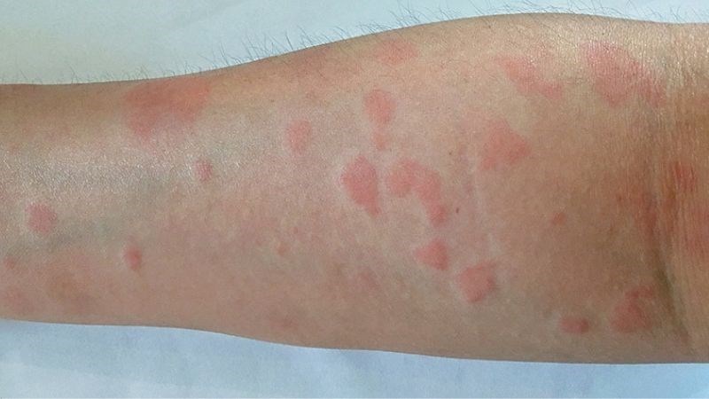 Lupus ban đỏ hệ thống là dạng phổ biến nhất Lupus ban đỏ hệ thống là dạng phổ biến nhất