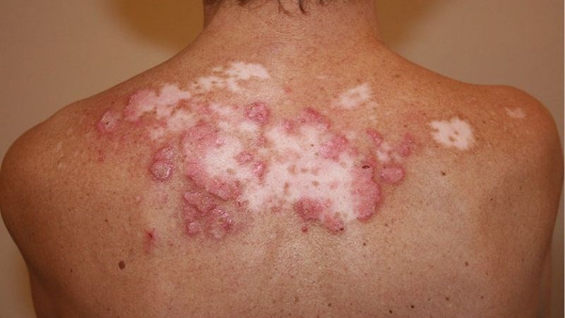 Lupus ban đỏ bán cấp đặc trưng bởi các vết loét màu đỏ không để lại sẹo Lupus ban đỏ bán cấp đặc trưng bởi các vết loét màu đỏ không để lại sẹo