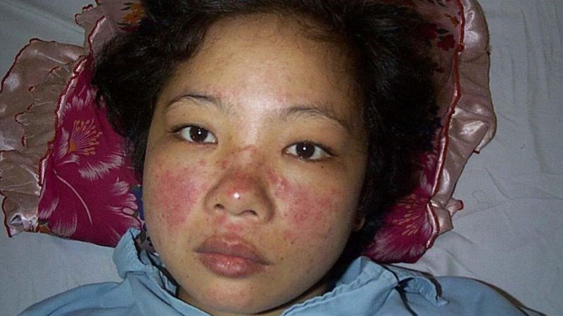 Phát ban dạng “cánh bướm” ở khu vực mũi và gò má Phát ban dạng “cánh bướm” ở khu vực mũi và gò má