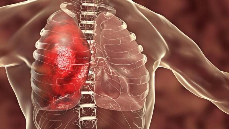Bị lupus làm tăng khả năng bị viêm niêm mạc khoang ngực khiến khó thở Bị lupus làm tăng khả năng bị viêm niêm mạc khoang ngực khiến khó thở