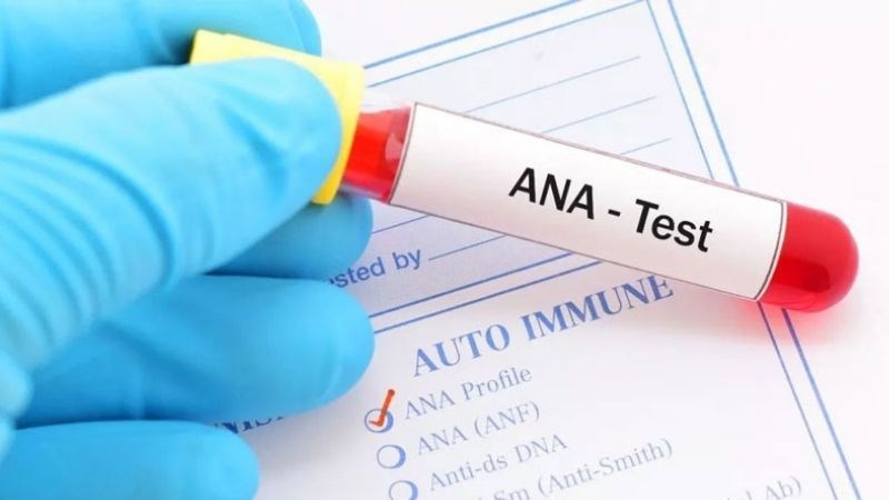 Hầu hết người mắc bệnh lupus đều có xét nghiệm ANA dương tính Hầu hết người mắc bệnh lupus đều có xét nghiệm ANA dương tính