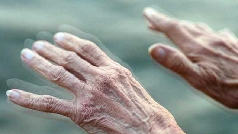 Một số bệnh lý thần kinh như Parkinson có thể kèm theo mất vị giác hoàn toàn