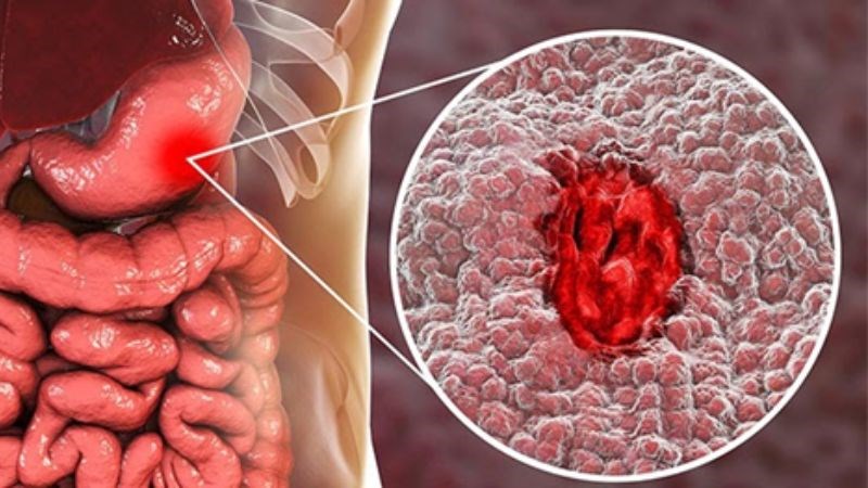 Viêm loét dạ dày là nguyên nhân gây nóng rát dạ dày