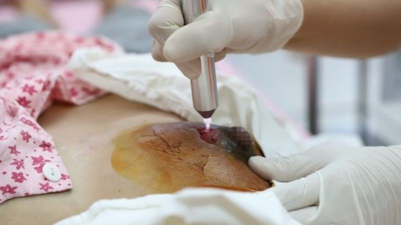 Nhiễm trùng, áp xe vú cũng là nguyên nhân gây thụt núm vú