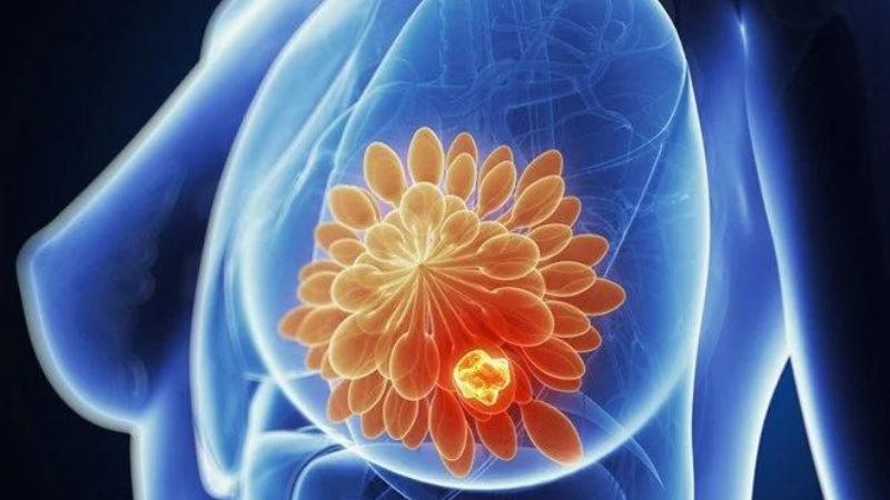 Núm vú bị thụt là triệu chứng sớm, thường gặp trong ung thư vú