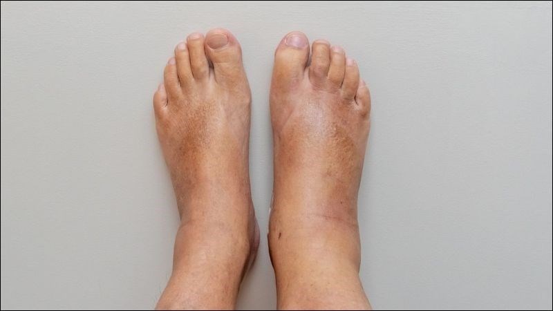 Người bệnh thường kèm theo dấu hiệu sưng phù chân