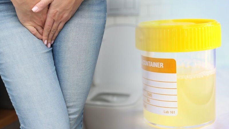 Nước tiểu đục là tình trạng nước tiểu chuyển sang màu trắng hoặc vàng sữa Nước tiểu đục là tình trạng nước tiểu chuyển sang màu trắng hoặc vàng sữa