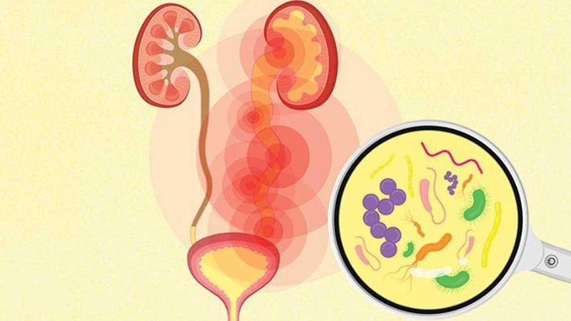 Nước tiểu đục là triệu chứng hay gặp của nhiễm trùng đường tiết niệu Nước tiểu đục là triệu chứng hay gặp của nhiễm trùng đường tiết niệu