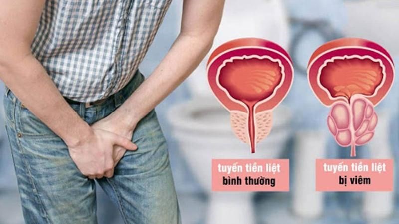 Bệnh lý tuyến tiền liệt có thể gây ra nước tiểu đục do ứ đọng Bệnh lý tuyến tiền liệt có thể gây ra nước tiểu đục do ứ đọng