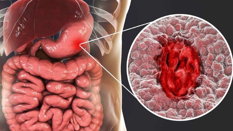 Ung thư dạ dày có thể dẫn đến đi ngoài phân đen