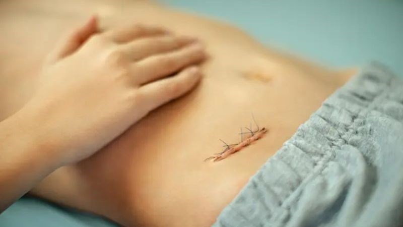 Ăn uống lành mạnh giúp vết mổ mau lành hơn