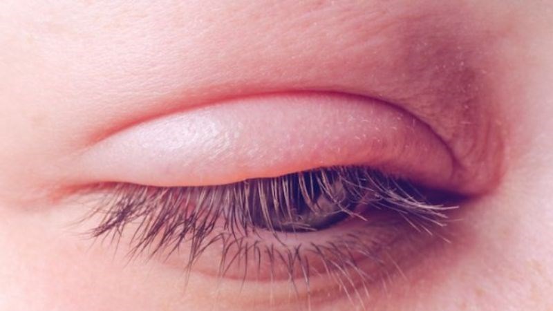 Sưng mí mắt là tình trạng tích tụ dịch tại phần mô liên kết lỏng lẻo quanh mắt