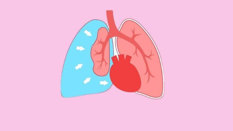 Tràn khí màng phổi sau chấn thương có thể gây suy hô hấp cấp Tràn khí màng phổi sau chấn thương có thể gây suy hô hấp cấp
