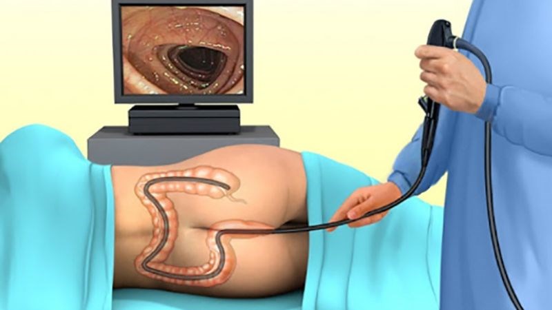 Nội soi đại trực tràng sẽ giúp phát hiện sớm ung thư ở vùng này