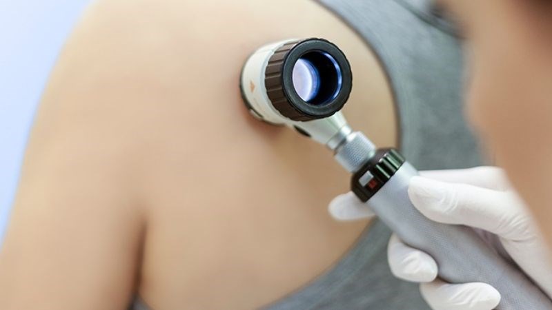Soi da có thể giúp bác sĩ chẩn đoán ung thư da sớm