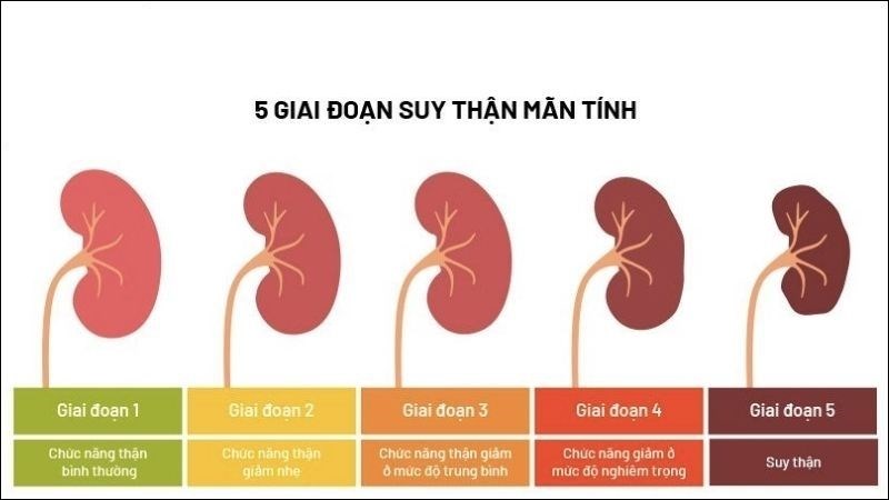 Bệnh suy thận mạn được chia l&agrave;m 5 giai đoạn theo mức độ nghi&ecirc;m trọng tăng dần