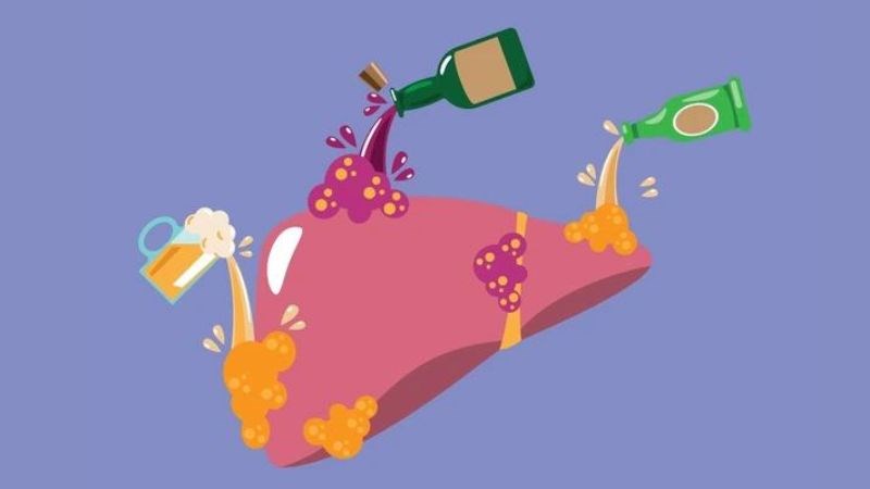 Viêm gan do rượu là bệnh lý xảy ra khi người bệnh lạm dụng rượu bia Viêm gan do rượu là bệnh lý xảy ra khi người bệnh lạm dụng rượu bia