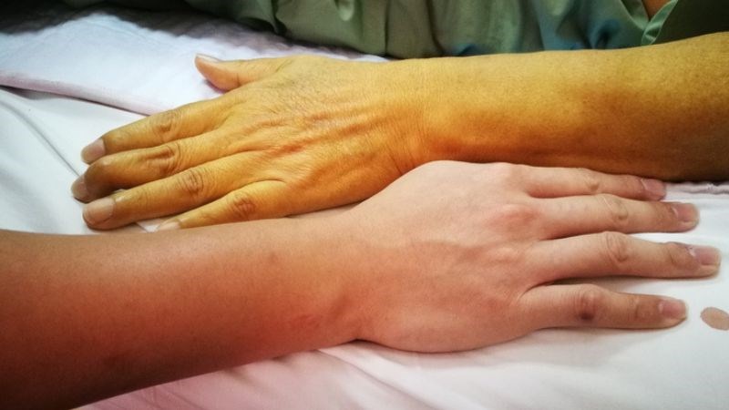 Vàng da là triệu chứng hay gặp của viêm gan do rượu Vàng da là triệu chứng hay gặp của viêm gan do rượu
