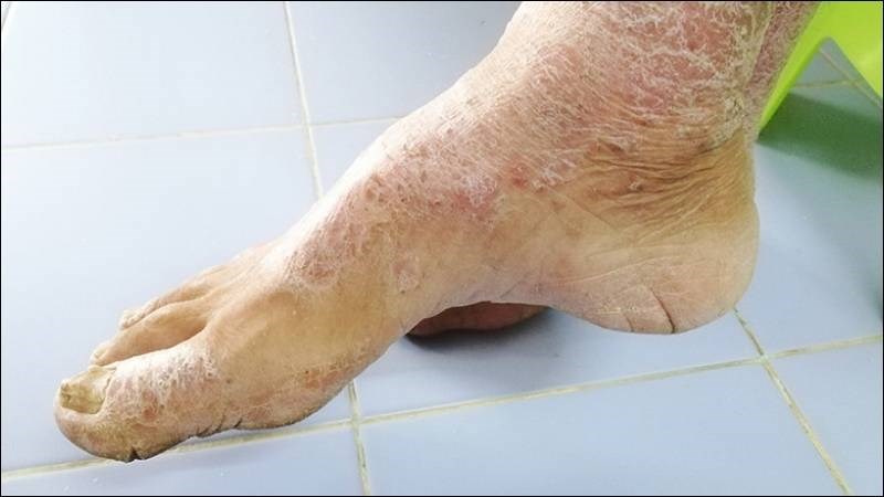 Bệnh xơ cứng bì có thể gây đau mắt cá chân