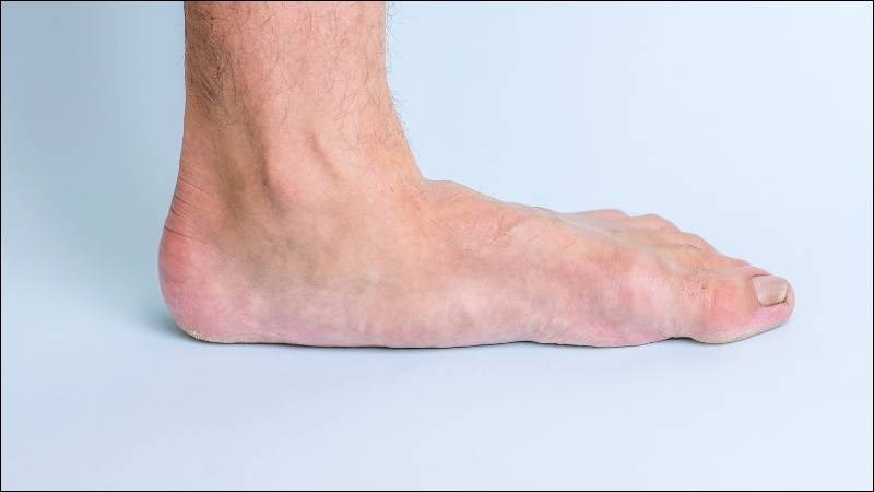 Bàn chân phẳng có thể khiến mắt cá chân bị đau