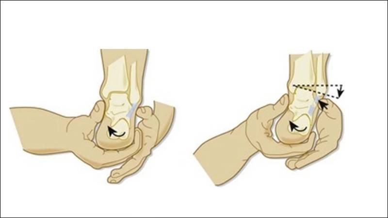Kiểm tra độ nghiêng Talar để kiểm tra độ lỏng lẻo của ở mắt cá chân