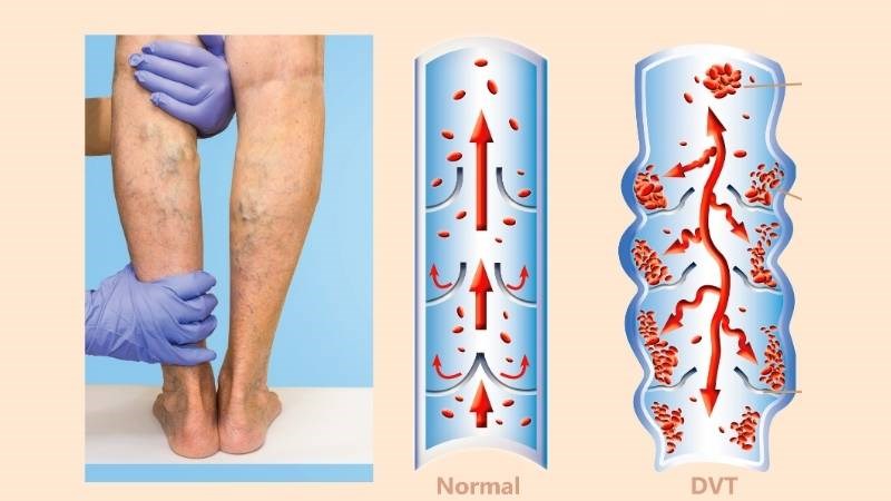 Huyết khối tĩnh mạch sâu gây đau, sưng và nóng ở mắt cá chân