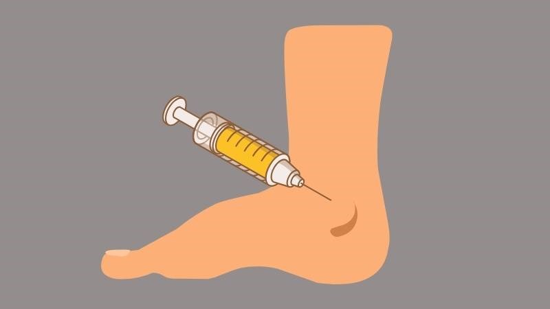 Hút dịch khớp giúp giảm áp lực trong khớp cổ chân, từ đó giảm đau và sưng
