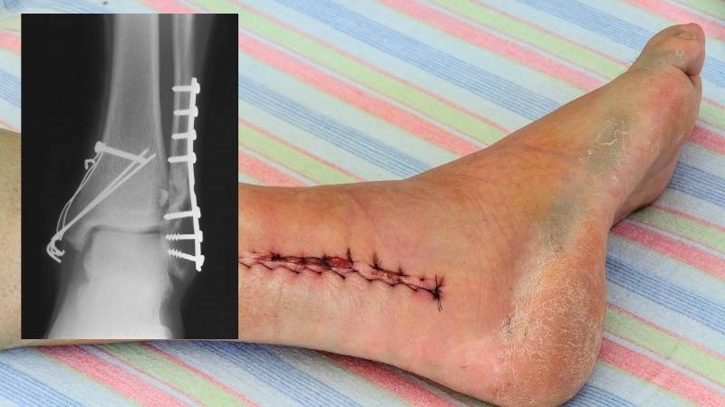 Phẫu thuật kết hợp xương thực hiện khi gãy xương mắt cá chân nghiêm trọng