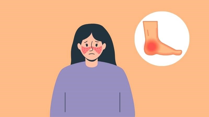 Lupus ban đỏ là bệnh tự miễn gây viêm khớp, bao gồm cả mắt cá chân