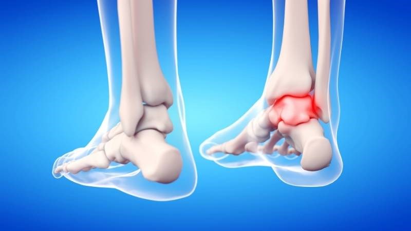 Viêm xương khớp mắt cá chân gây đau đớn khi xương ma sát trực tiếp với nhau