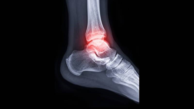 Nguyên nhân đau mắt cá chân có thể là do gãy xương