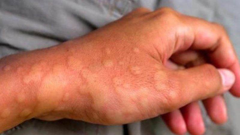 Khi nổi mề đay kèm hắt xì hoiw nhiều, người bệnh nên đến các cơ sở y tế để dược thăm khám
