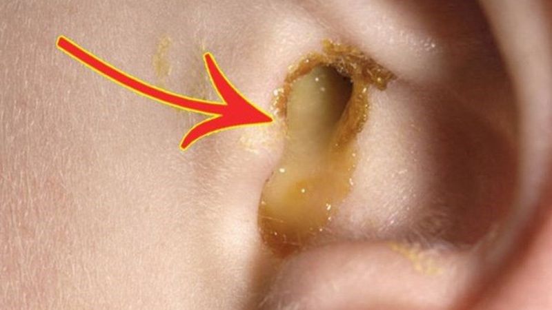 Tai chảy mủ vàng là dấu hiệu của nhiều bệnh lý Tai chảy mủ vàng là dấu hiệu của nhiều bệnh lý
