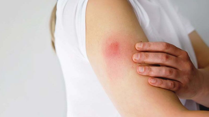 Quanh chỗ tiêm bị sưng đỏ là một trong những phản ứng sau khi tiêm vacxin Quanh chỗ tiêm bị sưng đỏ là một trong những phản ứng sau khi tiêm vacxin