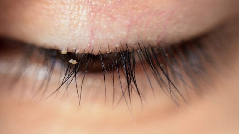 Viêm bờ mi có thể là nguyên nhân dẫn đến khô mắt