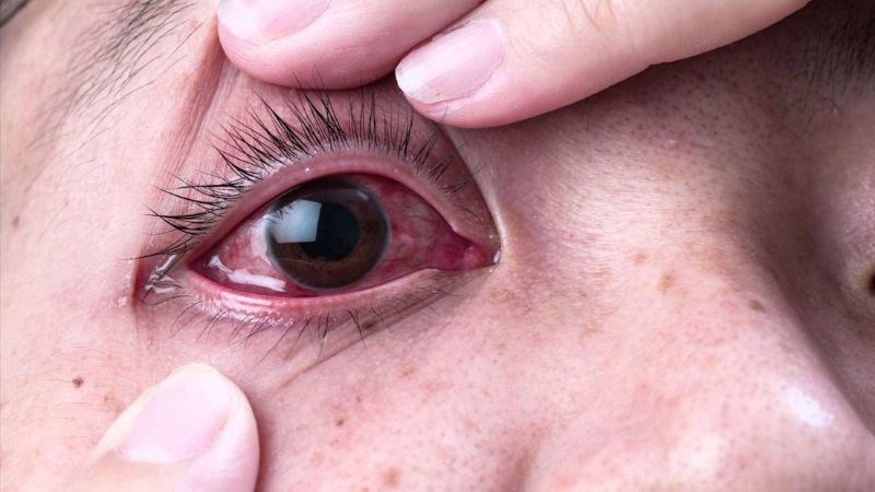 Đỏ mắt là triệu chứng thường xuất hiện cùng với khô mắt
